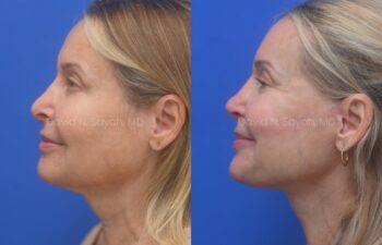 Facelift, Neck Lift, Lip Fat Grafting, Revison Rhinoplasty, Co2 laser Before ans After | Sayah Institute, left side view