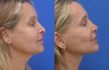 Facelift, Neck Lift, Lip Fat Grafting, Revison Rhinoplasty, Co2 laser Before ans After | Sayah Institute, left side view