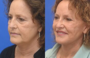 Facelift, Necklift Before and After | Sayah Institute, left oblique view