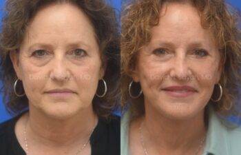 Facelift, Necklift Before and After | Sayah Institute, front view