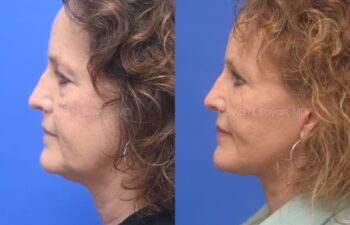 Facelift, Necklift Before and After | Sayah Institute, left side view