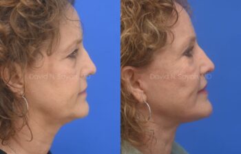 Facelift, Necklift Before and After | Sayah Institute, right side view