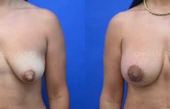 Patient before and 9 months after breast augmentation showing improved volume and natural results, front view.