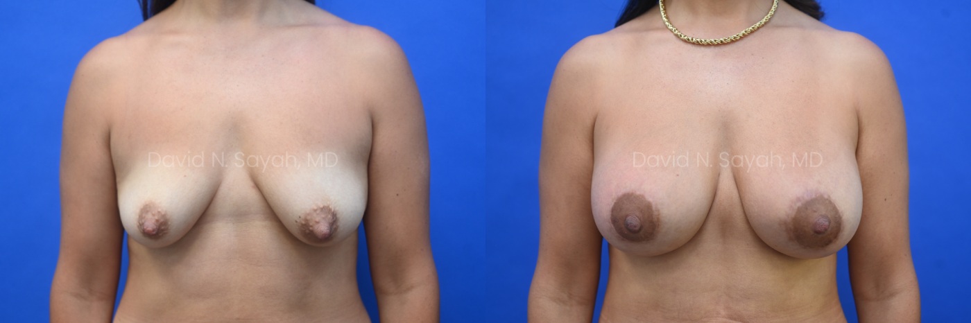 Patient before and 9 months after breast augmentation showing improved volume and natural results, front view.