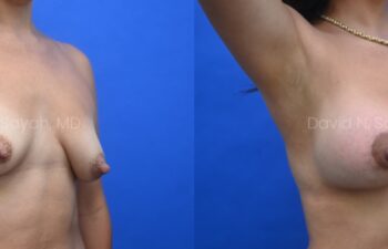 Patient before and 9 months after breast augmentation showing improved volume and natural results, right oblique arm raised.
