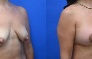 Patient before and 9 months after breast augmentation showing improved volume and natural results, right oblique view.