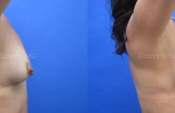 Patient before and 9 months after breast augmentation showing improved volume and natural results, right side view.
