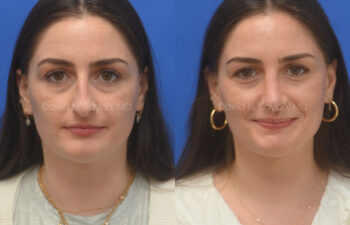 female patient before and after nose lipo and rhinoplasty