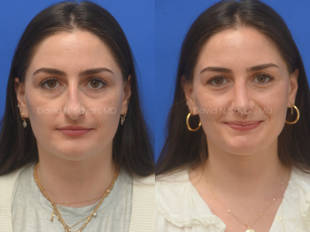 female patient before and after nose lipo and rhinoplasty