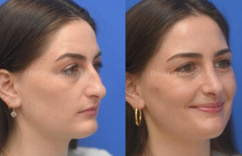 female patient before and after nose lipo and rhinoplasty