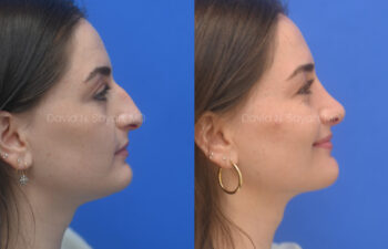female patient before and after nose lipo and rhinoplasty