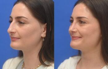 female patient before and after nose lipo and rhinoplasty
