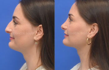 female patient before and after nose lipo and rhinoplasty