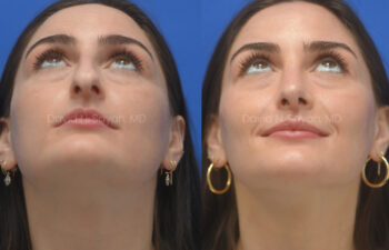 female patient before and after nose lipo and rhinoplasty