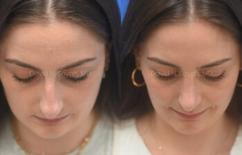 female patient before and after nose lipo and rhinoplasty