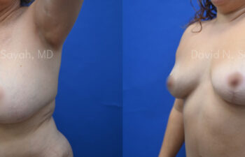 before / after under Breast Reduction