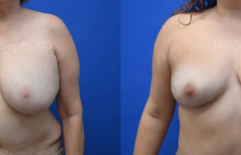 before / after under Breast Reduction